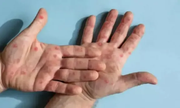 Mpox Cases Reported In Pakistan Amid Outbreak